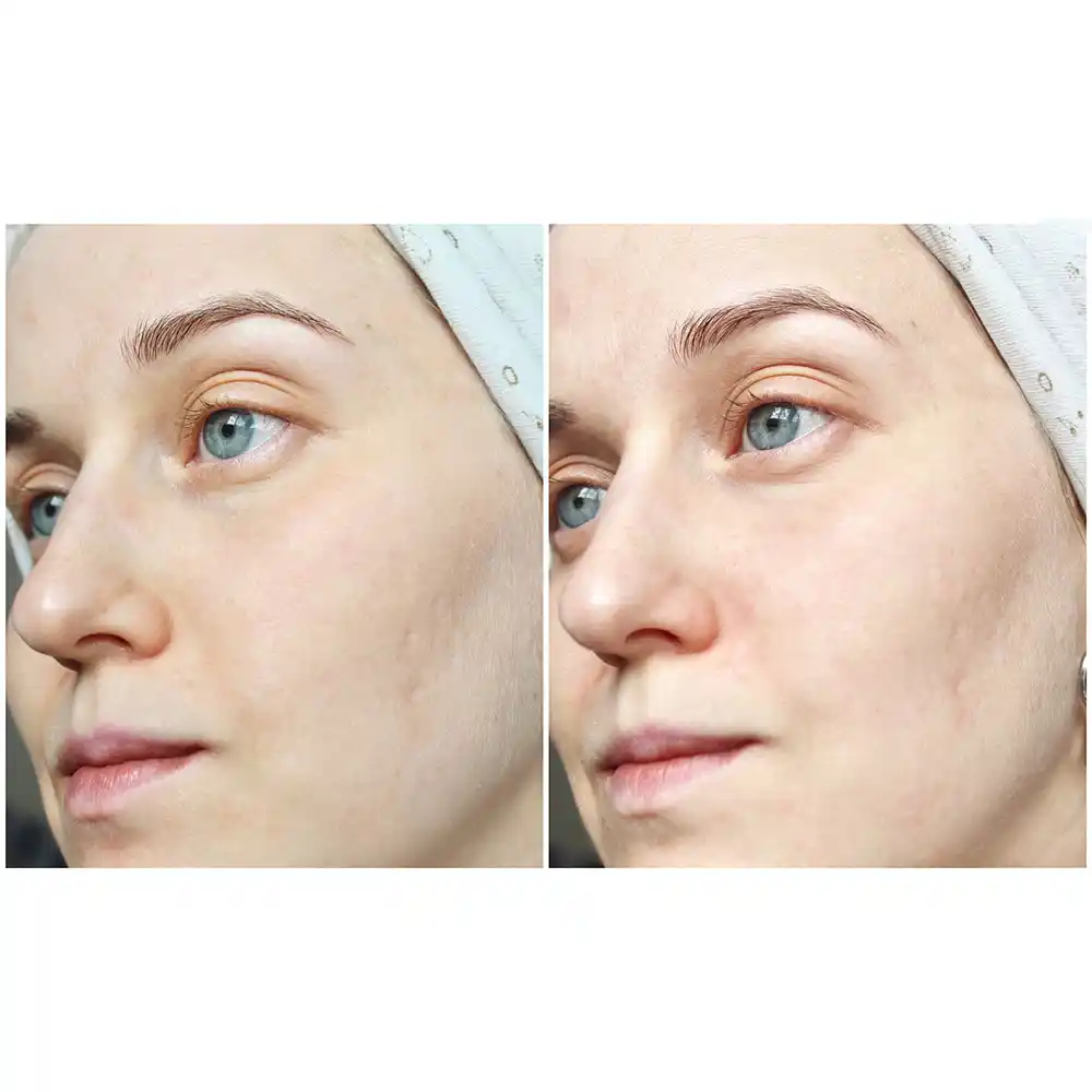 ژل شستشوی صورت سبیوم بایودرما Bioderma Sebium Gel Moussant | پوست چرب و مختلط مستعد آکنه