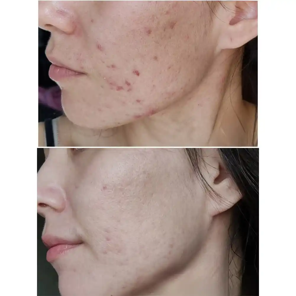 ژل شستشوی صورت سبیوم بایودرما Bioderma Sebium Gel Moussant | پوست چرب و مختلط مستعد آکنه