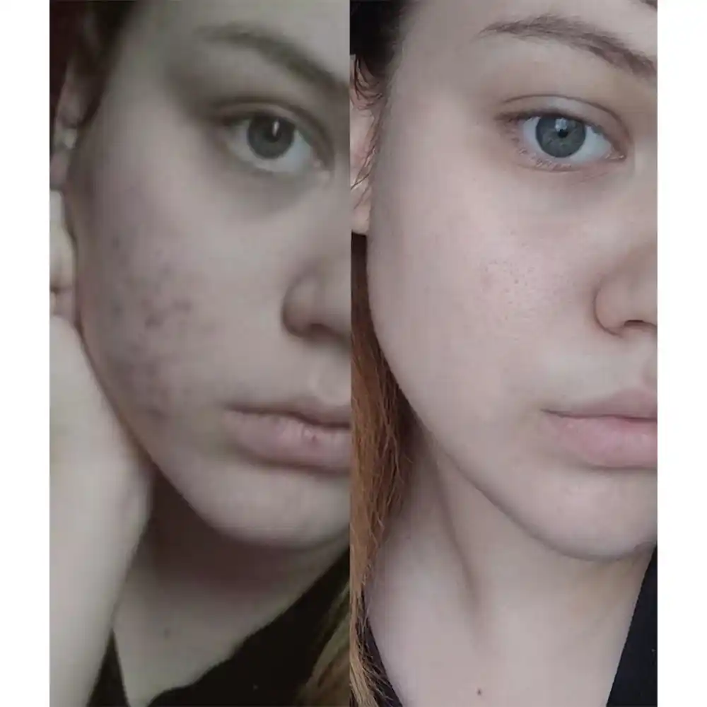 ژل شستشوی صورت سبیوم بایودرما Bioderma Sebium Gel Moussant | پوست چرب و مختلط مستعد آکنه