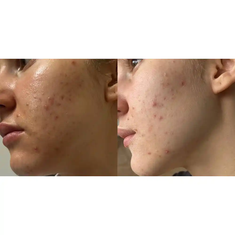ژل ضد جوش دیفرین آداپالن Differin Adapalene Gel 0.1% آمریکا درمان آکنه و لایه‌برداری رتینوئید