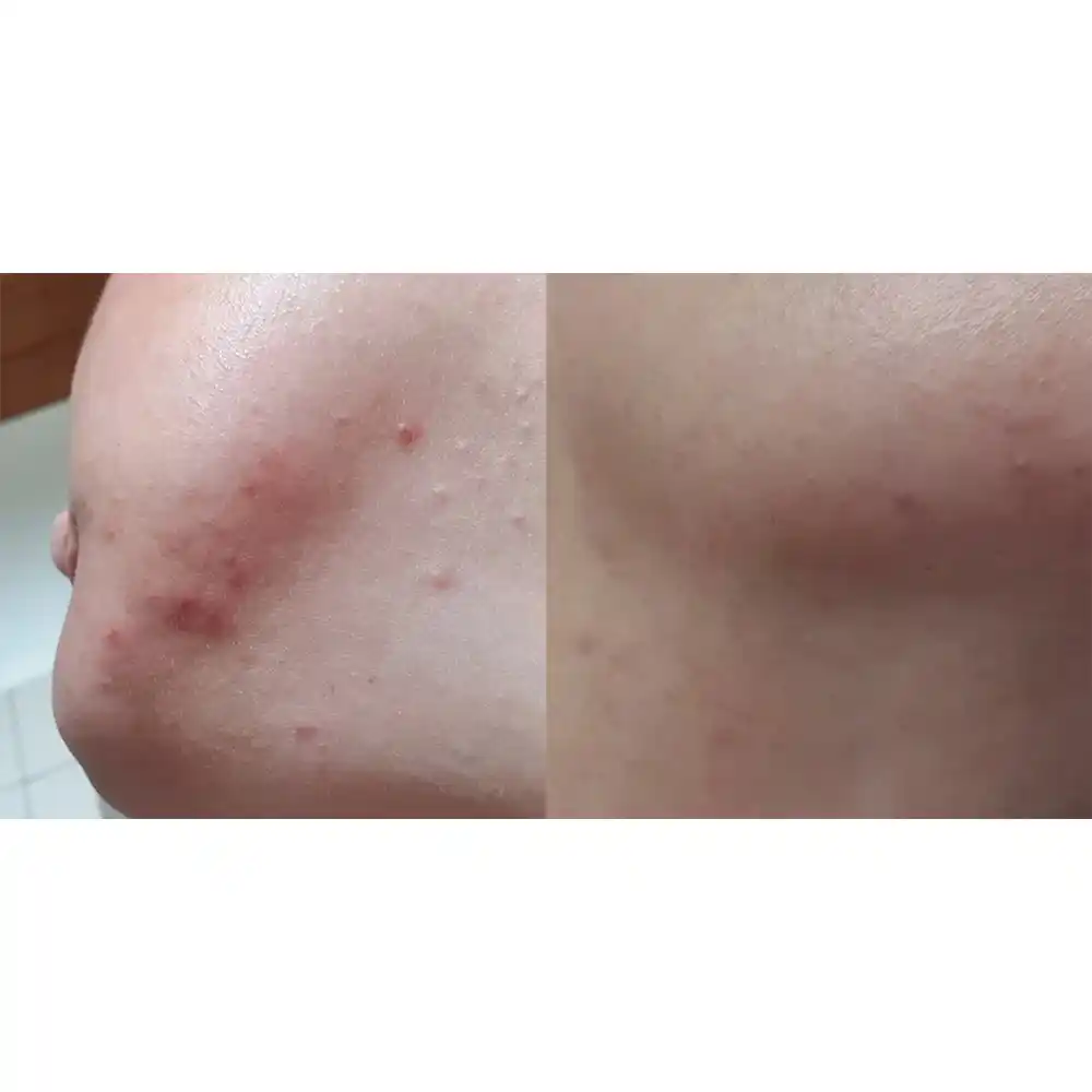 ژل ضد جوش دیفرین آداپالن Differin Adapalene Gel 0.1% آمریکا درمان آکنه و لایه‌برداری رتینوئید