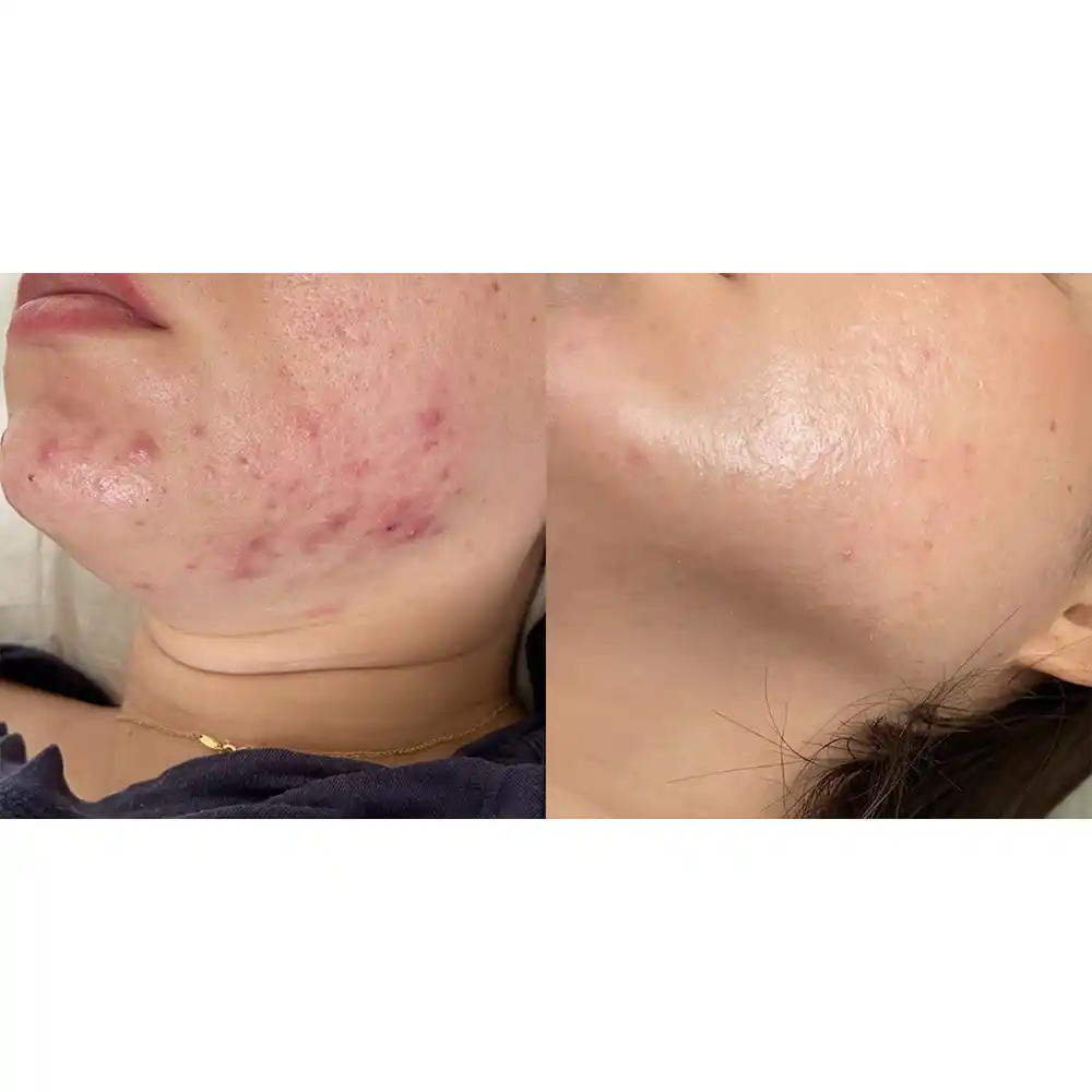 ژل ضد جوش دیفرین آداپالن Differin Adapalene Gel 0.1% آمریکا درمان آکنه و لایه‌برداری رتینوئید