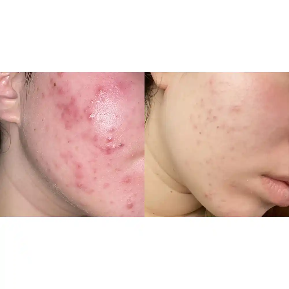 ژل ضد جوش دیفرین آداپالن Differin Adapalene Gel 0.1% آمریکا درمان آکنه و لایه‌برداری رتینوئید