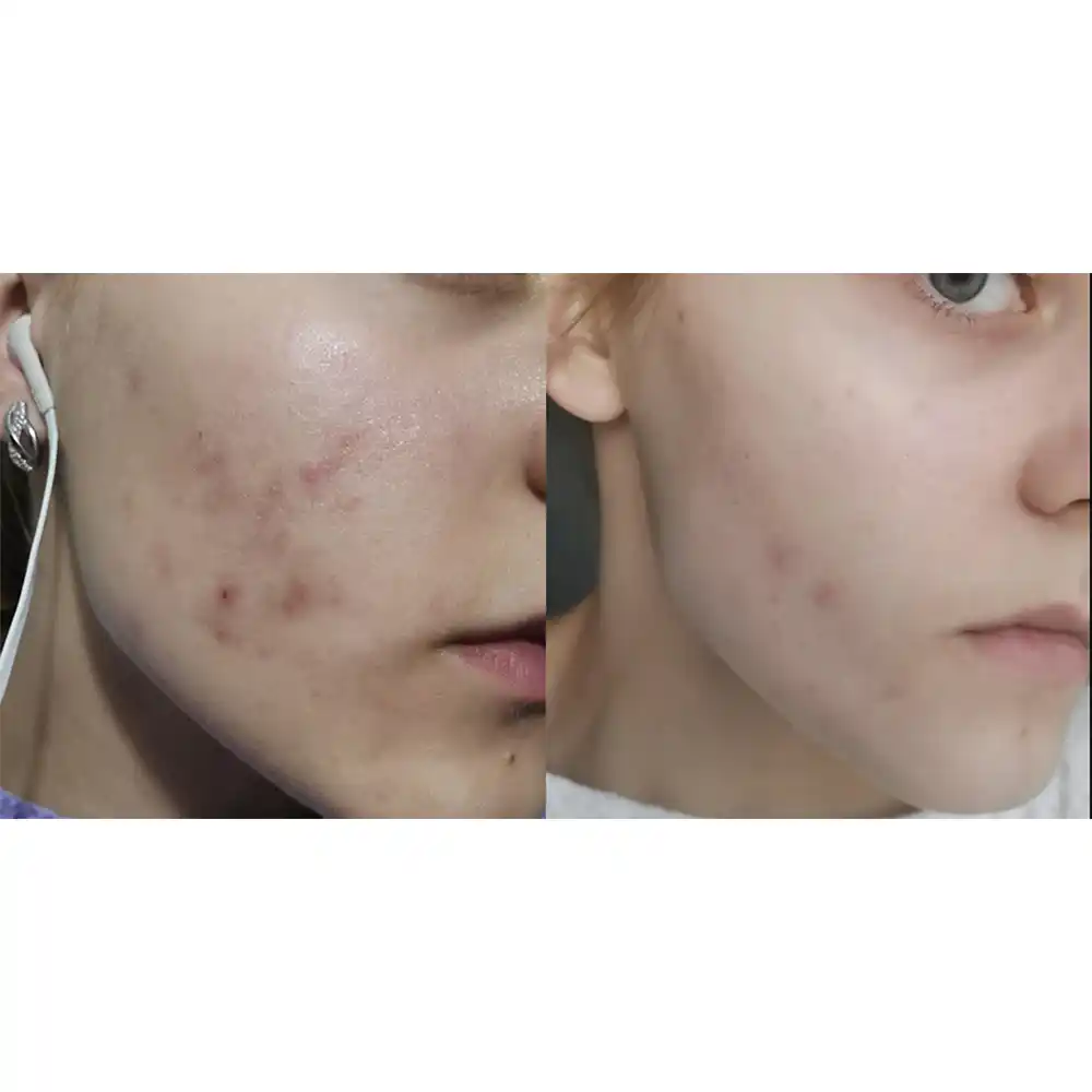 ژل ضد جوش دیفرین آداپالن Differin Adapalene Gel 0.1% آمریکا درمان آکنه و لایه‌برداری رتینوئید