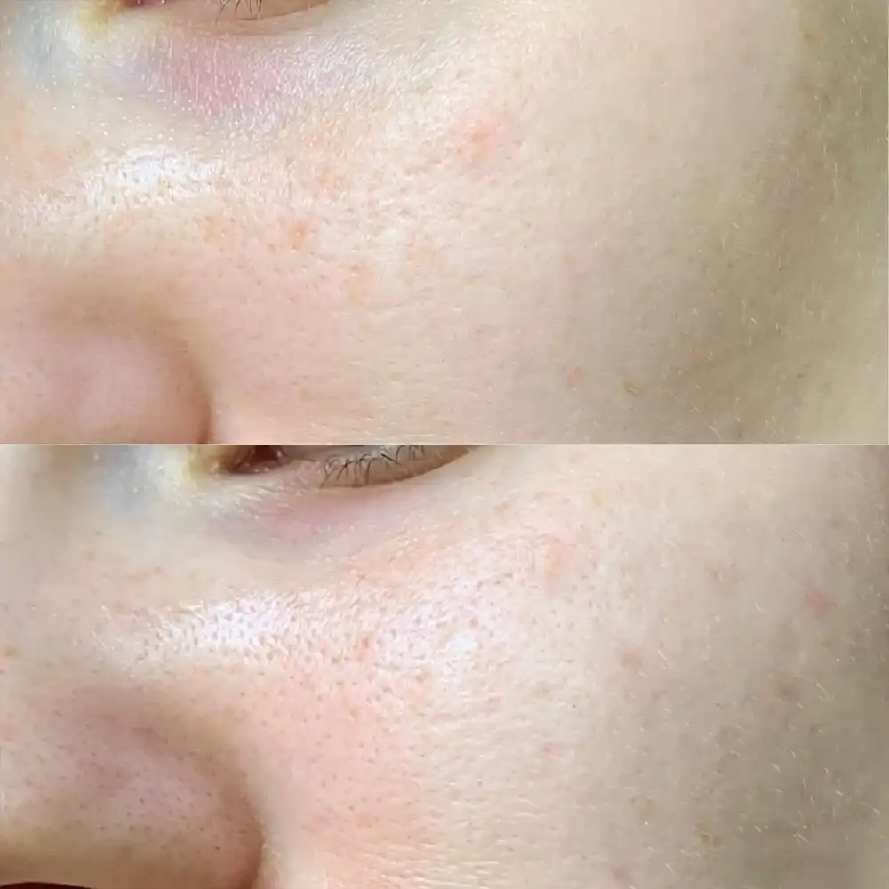 تونر ضد جوش 30 روزه سام بای می SOME BY MI AHA BHA PHA 30 Days Miracle Toner | کمک به کاهش ظاهر منافذ باز