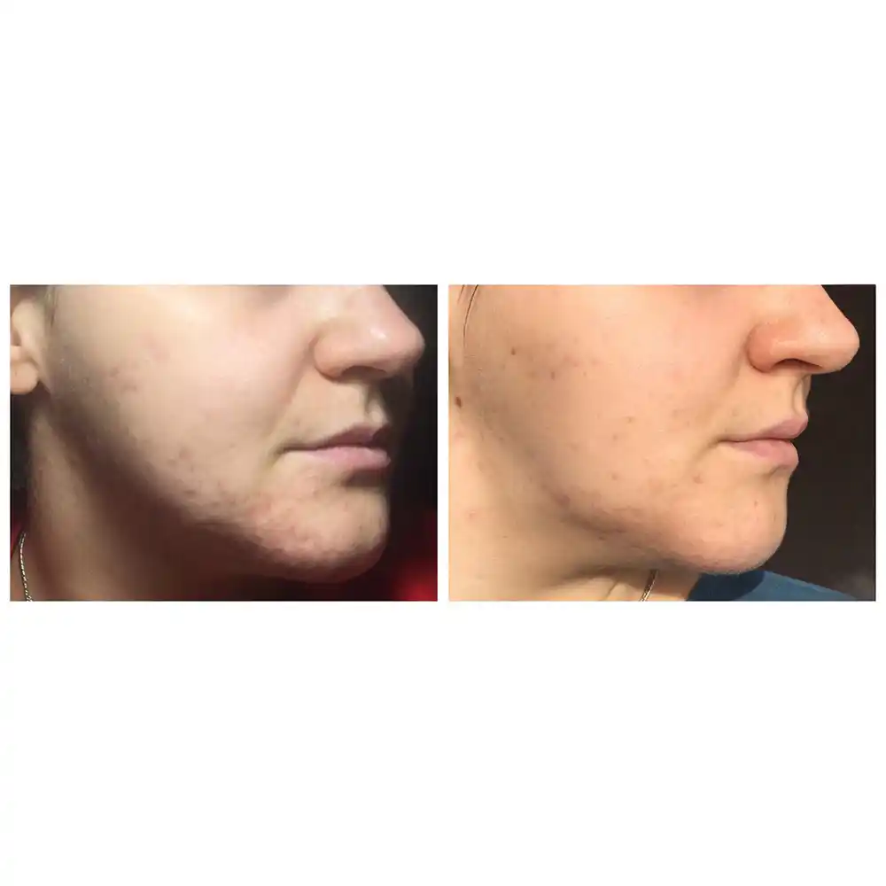 تونر ضد جوش 30 روزه سام بای می SOME BY MI AHA BHA PHA 30 Days Miracle Toner | کمک به کاهش ظاهر منافذ باز