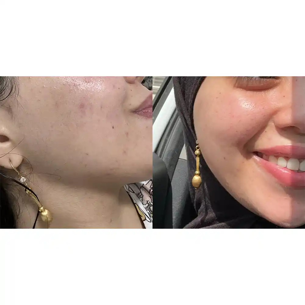 تونر ضد جوش 30 روزه سام بای می SOME BY MI AHA BHA PHA 30 Days Miracle Toner | کمک به کاهش ظاهر منافذ باز