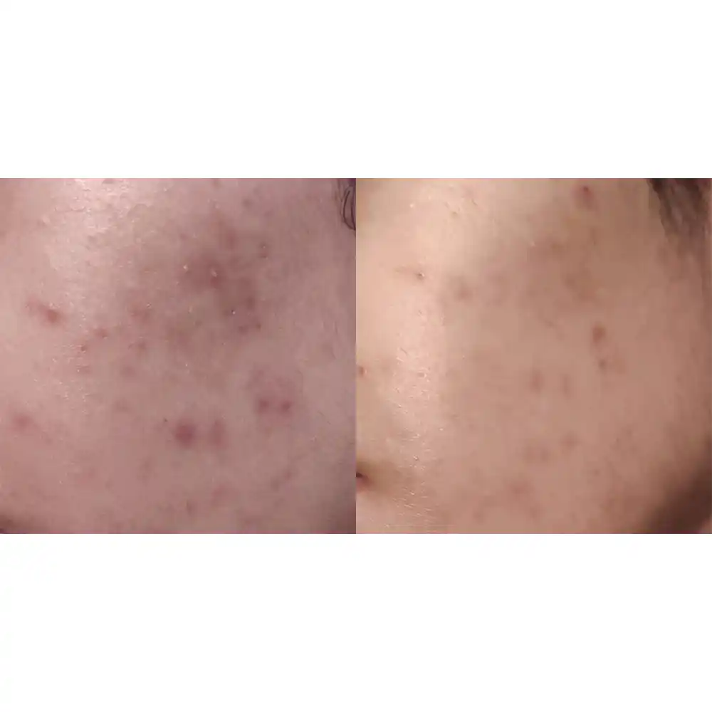 تونر ضد جوش 30 روزه سام بای می SOME BY MI AHA BHA PHA 30 Days Miracle Toner | کمک به کاهش ظاهر منافذ باز