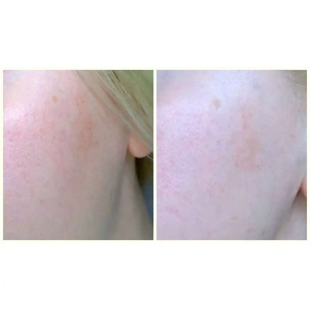 سرم ضد جوش سام بای می SOME BY MI AHA BHA PHA 30 Days Miracle Serum 50ml | کنترل چربی، کاهش جوش و منافذ باز