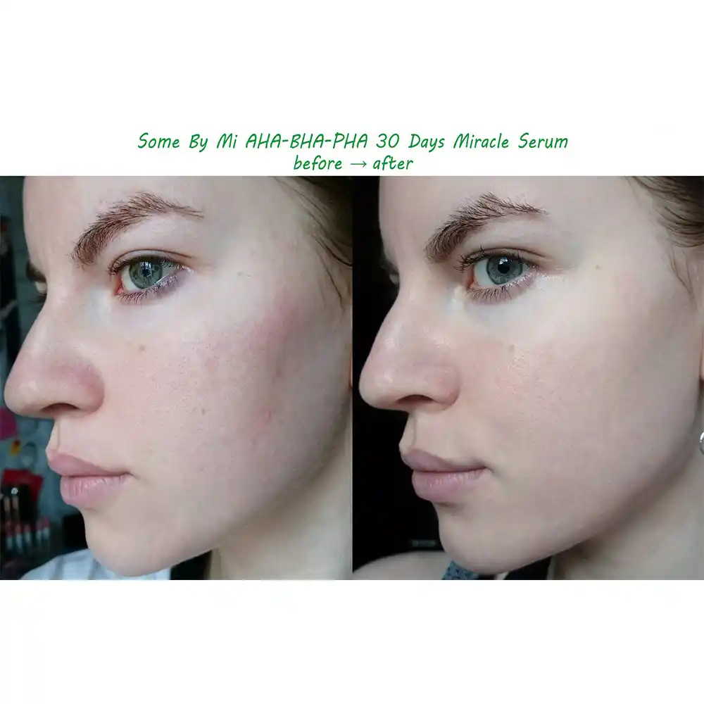 سرم ضد جوش سام بای می SOME BY MI AHA BHA PHA 30 Days Miracle Serum 50ml | کنترل چربی، کاهش جوش و منافذ باز