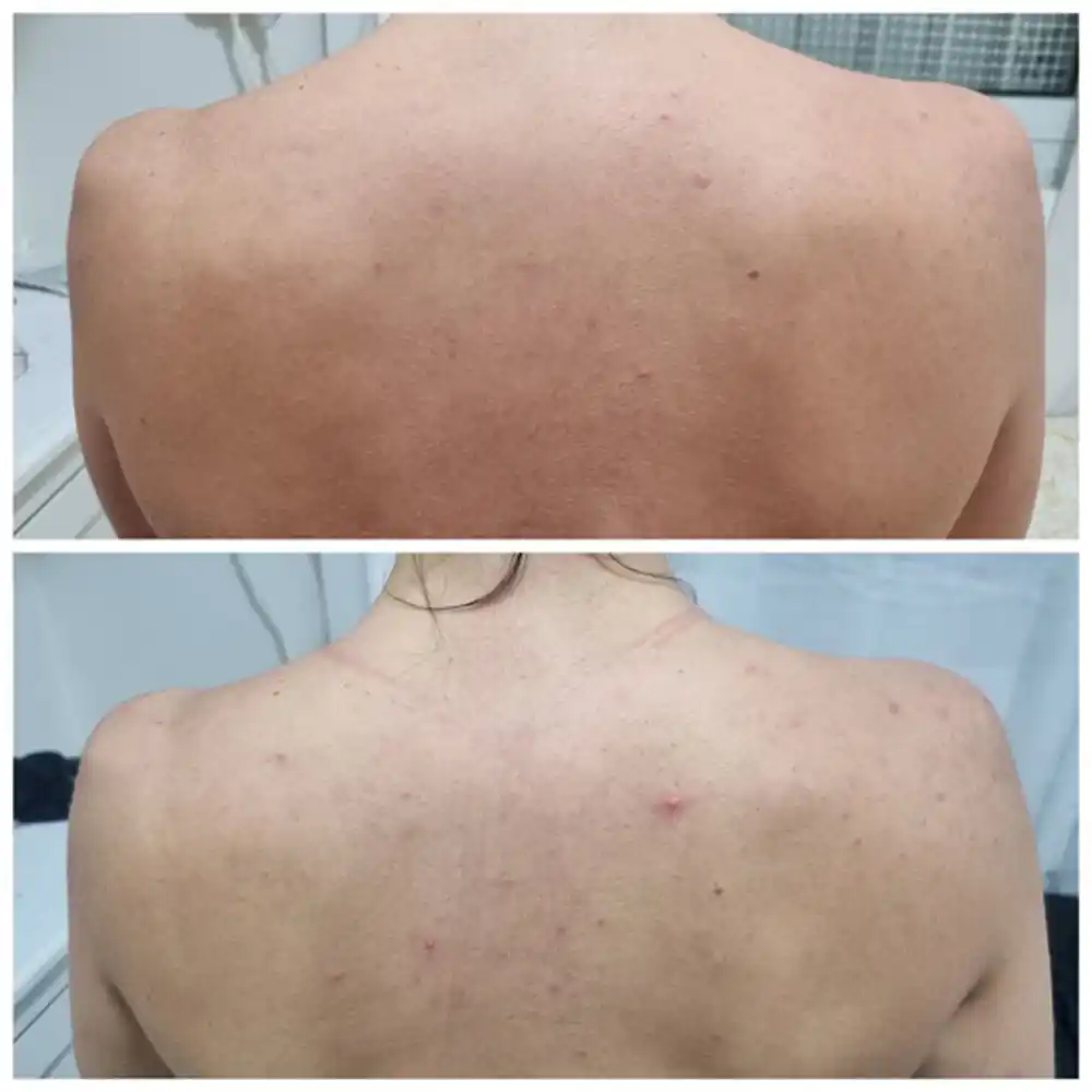 شوینده بدن ضد جوش 30 روزه میراکل سام بای می SOME BY MI Miracle Acne Clear Body Cleanser 400g | ضد جوش بدن و کاهش لک