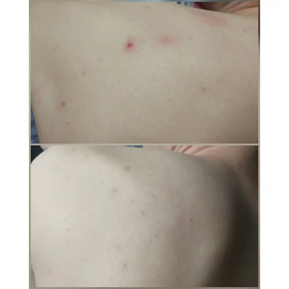 شوینده بدن ضد جوش 30 روزه میراکل سام بای می SOME BY MI Miracle Acne Clear Body Cleanser 400g | ضد جوش بدن و کاهش لک