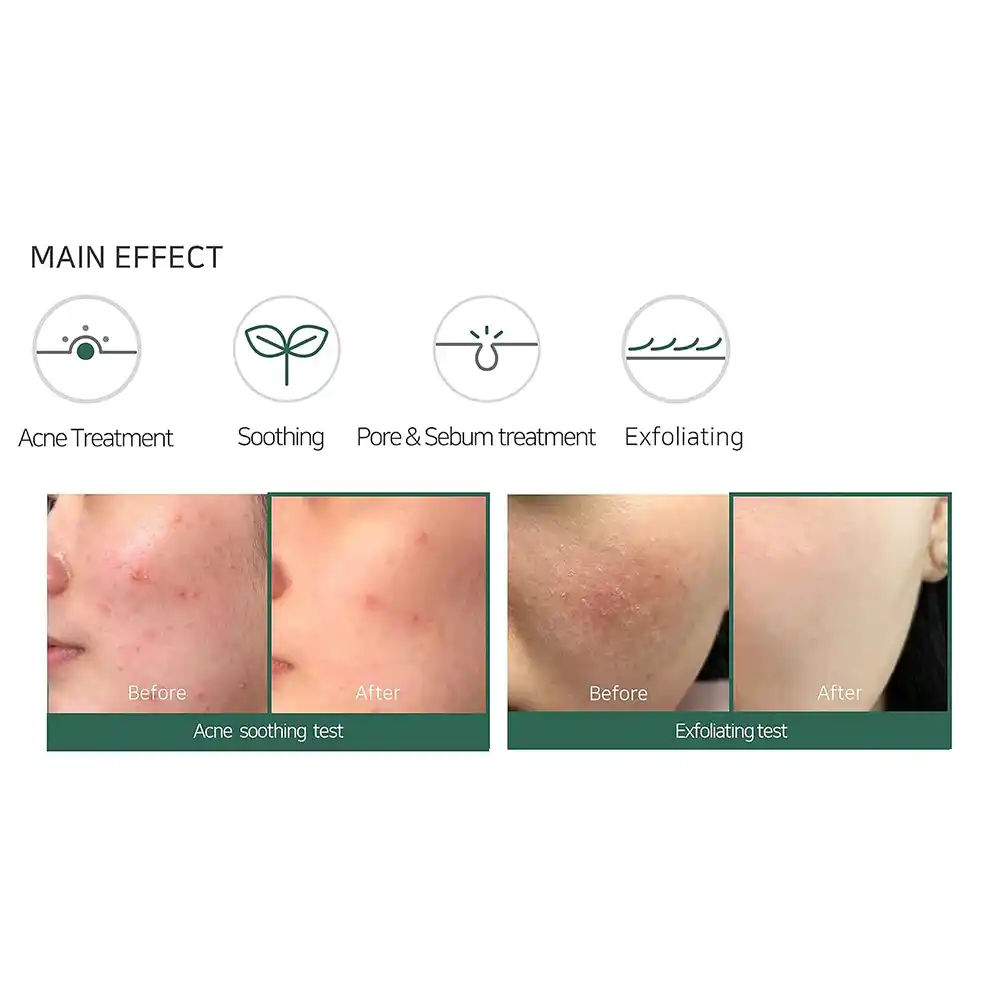 فوم ضد جوش لایه بردار میراکل سام بای می SOME BY MI AHA BHA PHA 30 Days Miracle Acne Clear Foam 100ml | پاکسازی منافذ و کنترل چربی