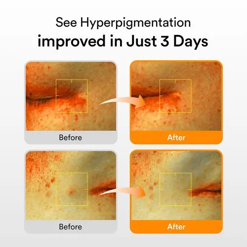 سرم ضد لک گلوتاتیون ابیب با ویتامین Abib Glutathiosome Dark Spot Serum Vita Drop | روشن شدن تیرگی کمک به کاهش لک و افزایش شفافیت پوست