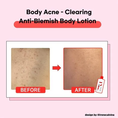 وسیون بدن ضد لک و روشن کننده تیام TIAM Anti-Blemish Body Lotion
